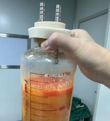 龙岩水动力吸脂手术要做多久？